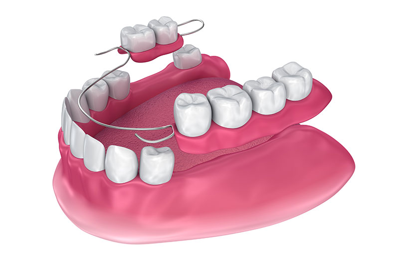 Partial Dentures Tampa